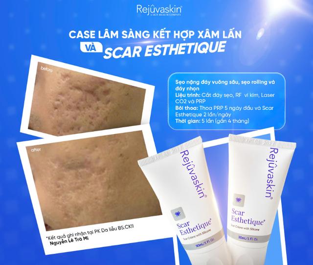 Review chi tiết kem Scar Esthetique làm mờ sẹo rỗ do mụn có tốt không?- Ảnh 7. Review chi tiết kem Scar Esthetique làm mờ sẹo rỗ do mụn có tốt không?- Ảnh 7.